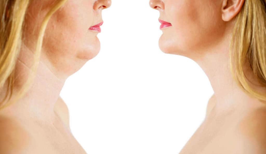 Double Chin treatment Norwich before and after results