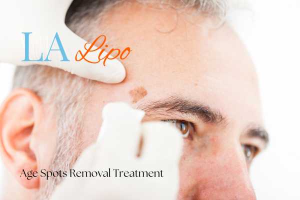 What Are the Most Effective Treatments for Age Spots Norwich?