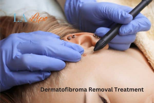 Dermatofibroma Removal Treatment Norwich