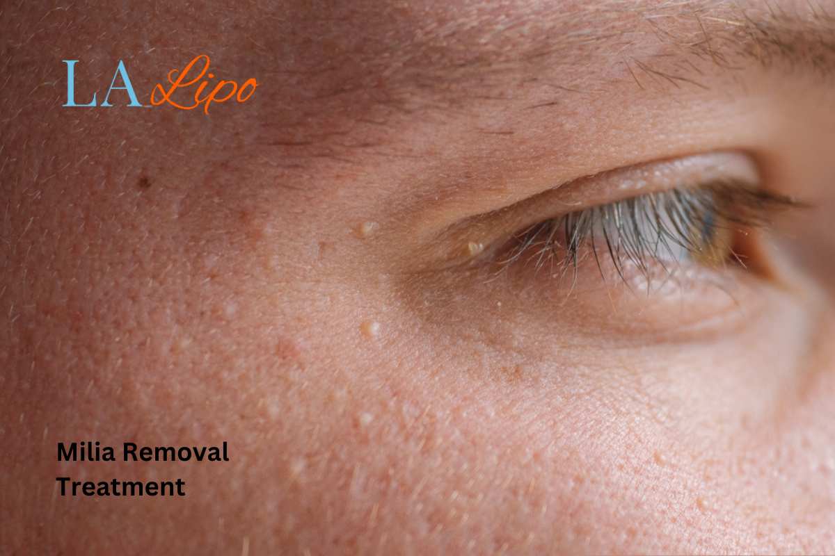 Cryopen Milia Removal: Is It the Easiest and Safest Option Norwich?