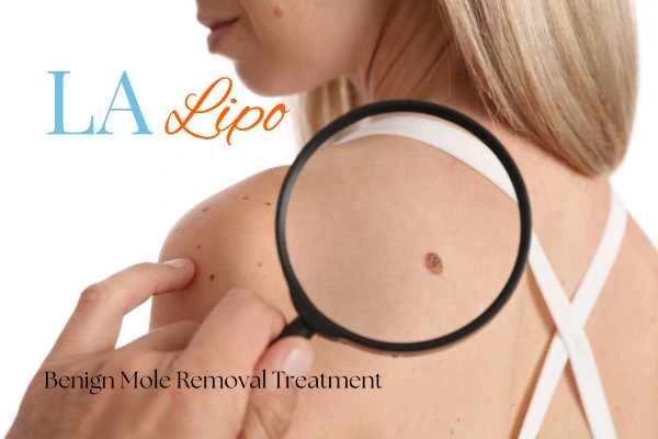 Woman having her inspection of blemish before mole removal Norwich