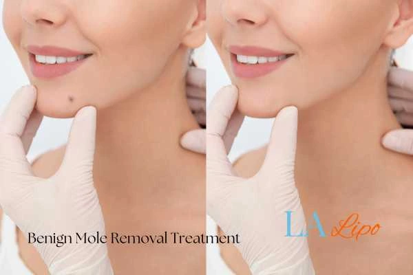 Before and after mole removal Norwich treatment