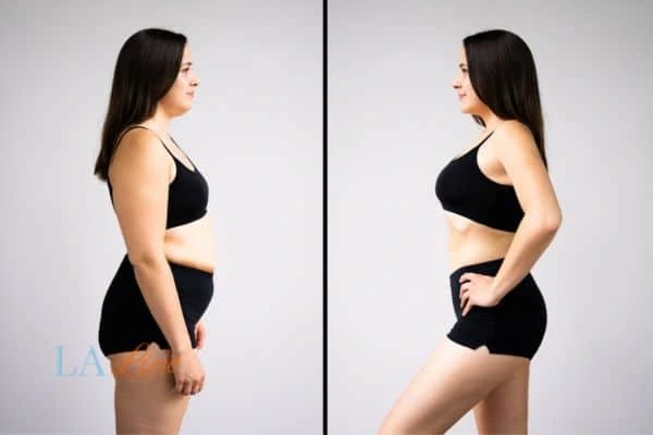 image of woman before and after results of LA-EMS Body Sculpting Norwich to help treat Diastasis recti
