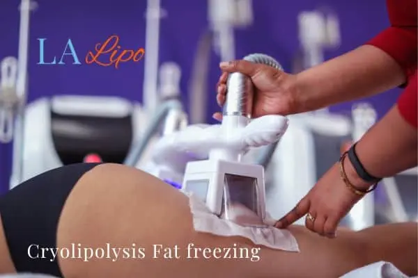 women getting fat freezing Norwich