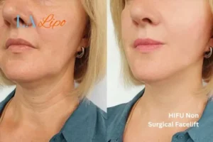 hi-fu for wrinkles Norwich before and after results