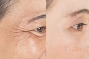 Before and after results of woman - HI-fu wrinkles reduction treatment Norwich