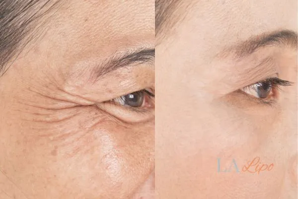 Before and after results of woman - HI-fu wrinkles reduction treatment Norwich