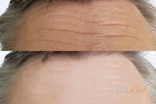 results of HIFU Norwich on mans forehead to help reduce lines and wrinkles