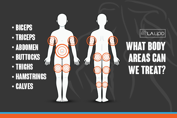 Graphic to show areas you can have LA-EMS Body Sculpting Norwich treatment.