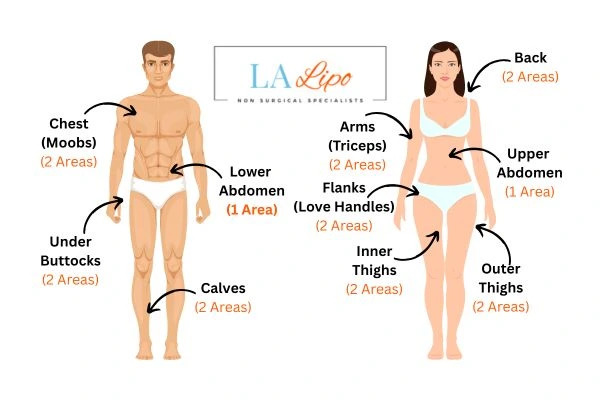 LA LIPO Cryolipolysis Areas Norwich