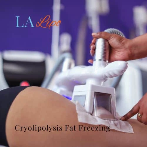 fat freezing - Cryolipolysis Norwich