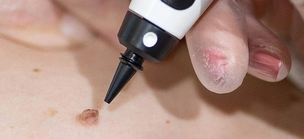 skin tag removal using cryopen Norwich