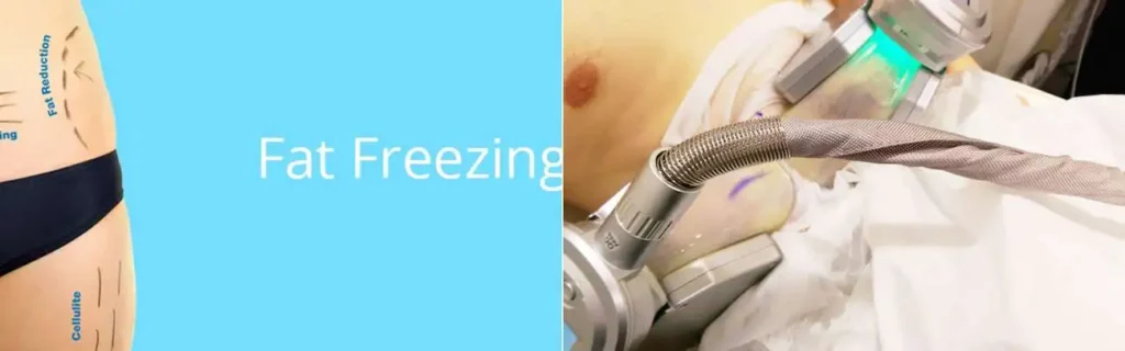 Fat freezing Norwich on multiple areas of the body