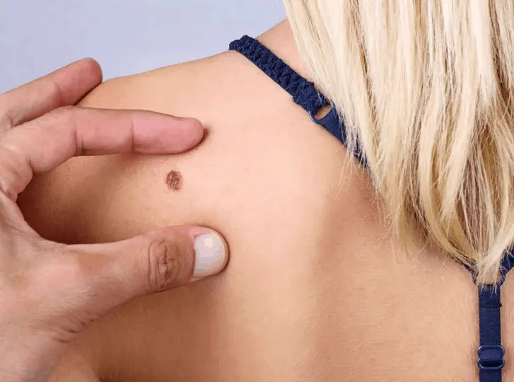 woman having mole removal Norwich consultation before treatment.