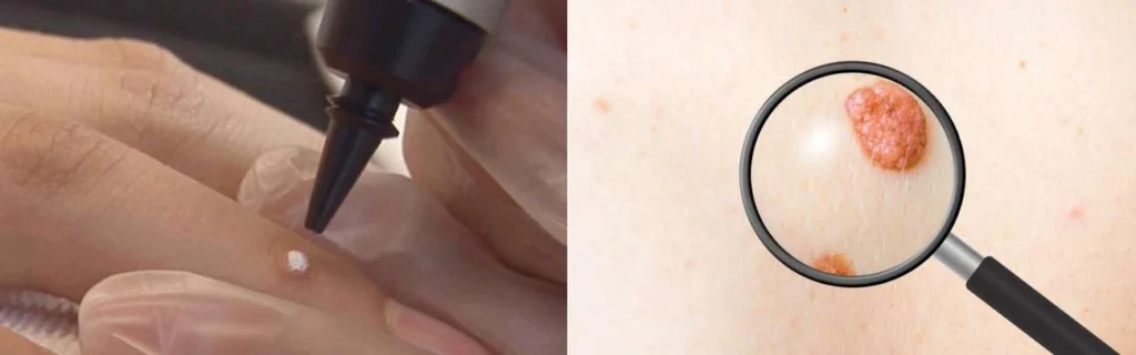 Person getting moles removed with cryopen Norwich