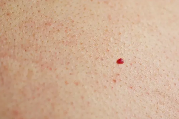 close up of a cherry angioma Norwich