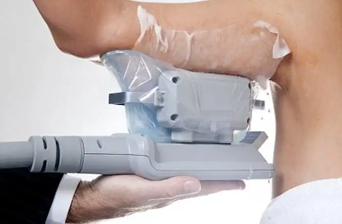 Picture of fat freezing Norwich on the upper arms.