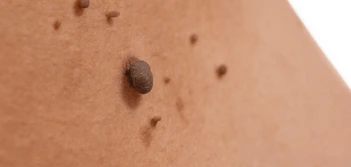 image of a skin tag Norwich