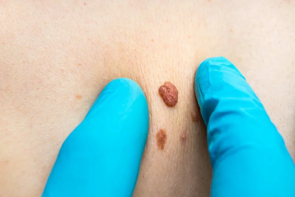 Consultant examining a skin tag Norwich