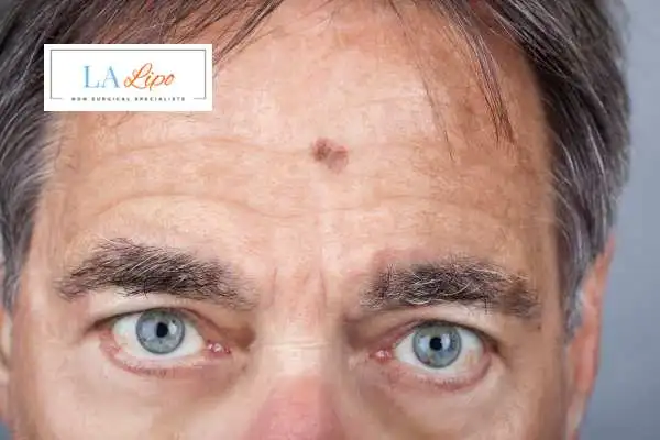 Solar Lentigo Removal Norwich image of man with mark on his forehead