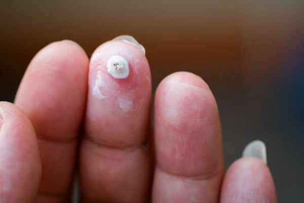 wart on person finger - cryotherapy to treat from LA LIPO Norwich