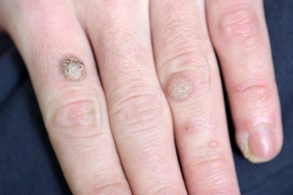 photo of warts on person hand - see wart removal Norwich from LA LIPO