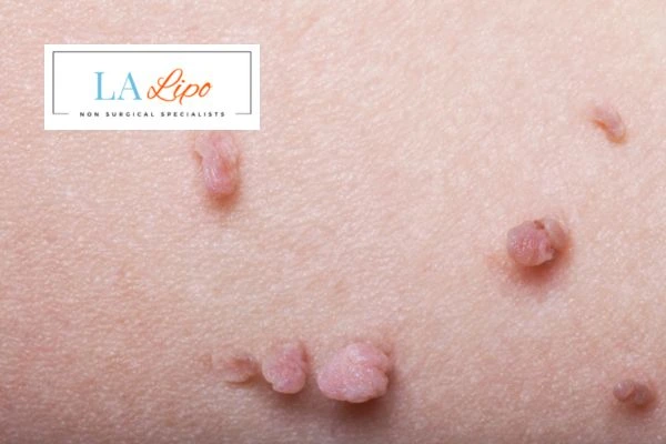 Does cryopen skin tag removal Norwich hurt? Find out now call our team today!