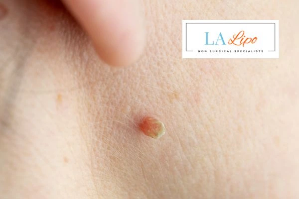 Book skin tag removal Norwich today speak to our team now!