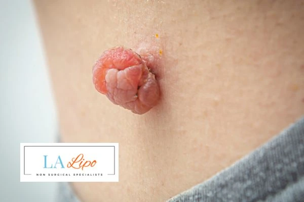 Interested in skin tag removal Norwich? Concerned about the pain? Find out more today!
