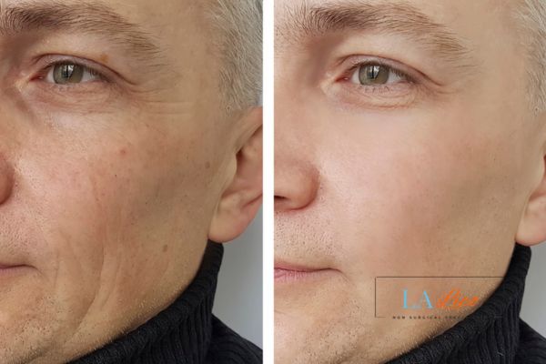 See the amazing results of Morpheus8 Treatment Norwich!