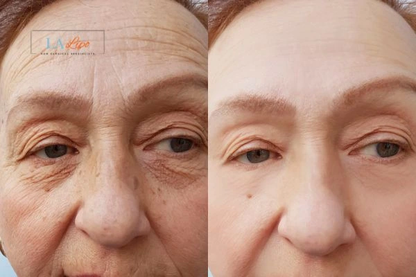 The powerful benefits of Morpheus8 Treatment Norwich - Call Our team today!