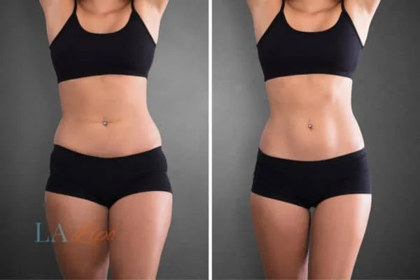 before and after results of non-surgical treatment to help a woman's body image and mental health Norwich