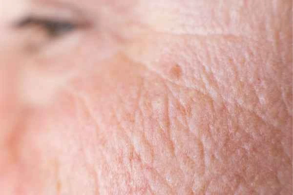 close up picture of a woman's face showing an age spot Norwich