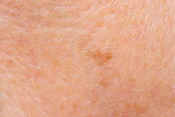 close up picture of age spots Norwich