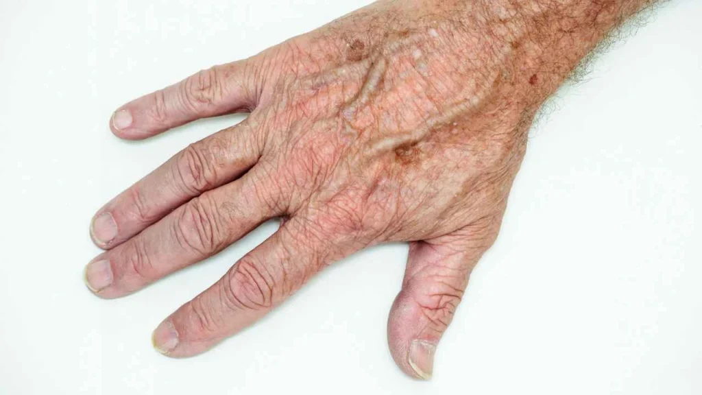Male hand showing age spot Norwich
