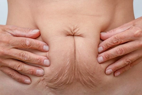 Image of a woman's stomach with loose skin - example of skin tightening Norwich options